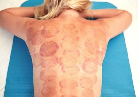 woman with traces of cupping massage