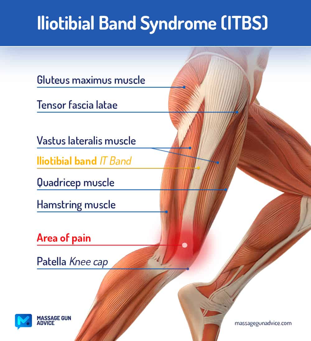 Iliotibial Band Syndrome Itbs