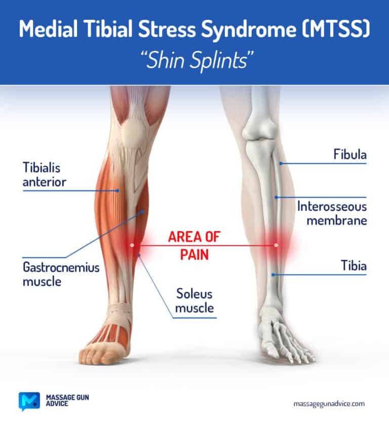 Massage Gun For Shin Splints Can It Help? And Which One?