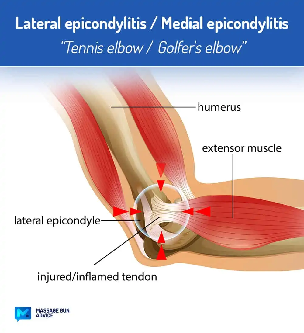 https://massagegunadvice.com/wp-content/uploads/2022/11/Tennis-elbow-Golfers-elbow.webp