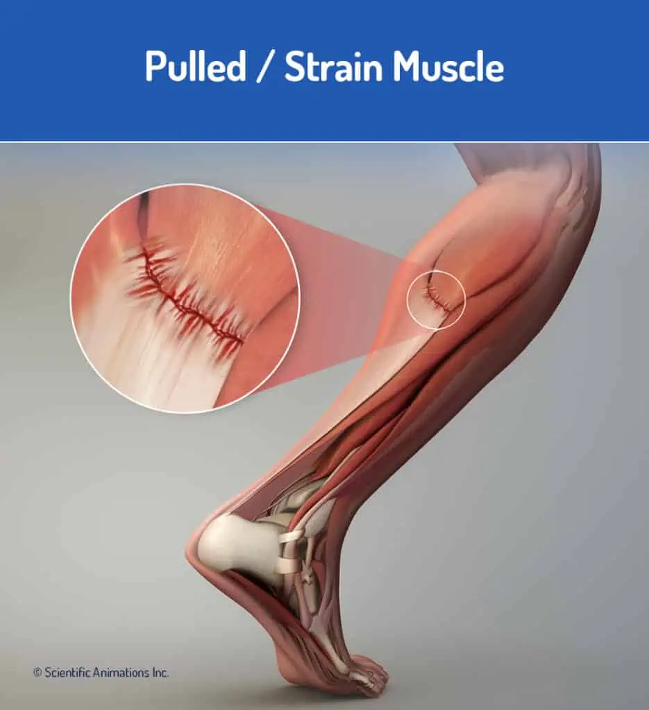 Pulled Muscle Muscle Strain